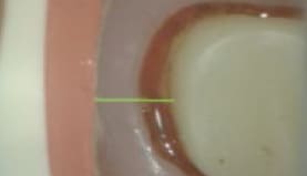 octix-process-without-cord-octix-1
